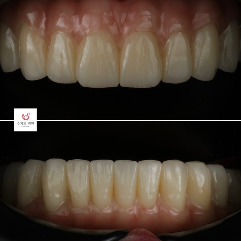 Apgujeong Straumann Implant_ All-on-X image 3