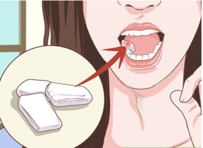 발치, 임플란트, 치조골 이식 수술 후 주의사항 관련 이미지 1