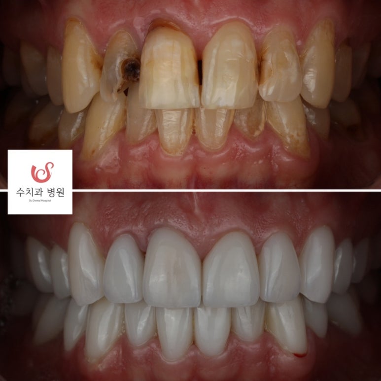 English speaking dentist in Seoul (feat. Veneers in South Korea) 관련 이미지 2