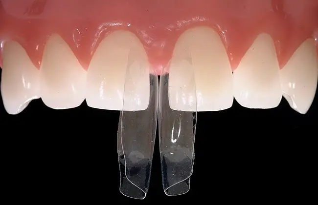 Changwon Gapped Teeth: A No-Prep BioClear Resin Veneer Case image 2