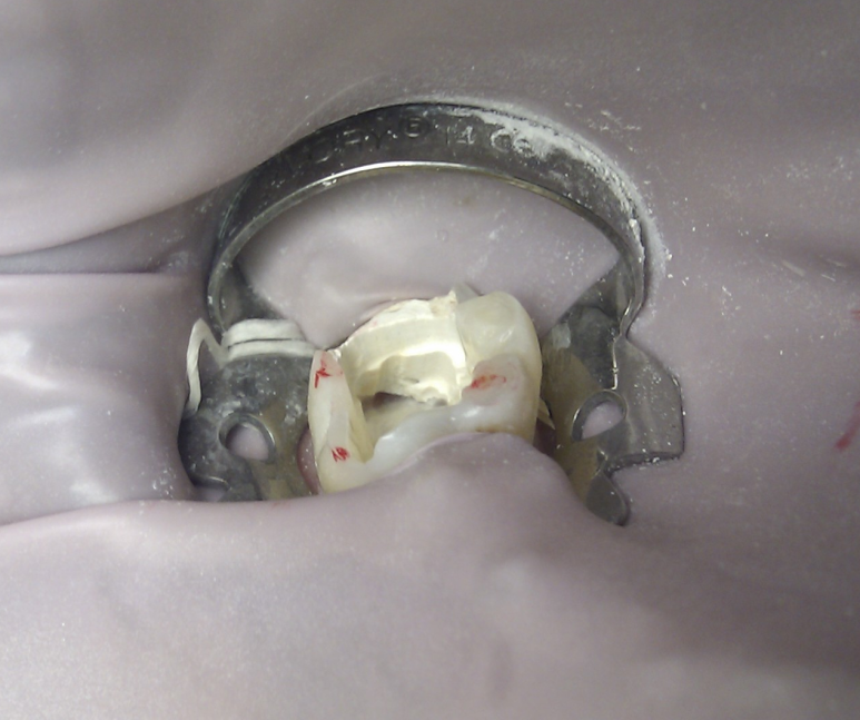 Precautions After Root Canal Treatment image 2