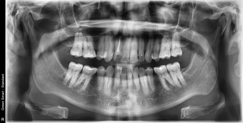 English speaking dentist in Seoul (feat. Veneers in South Korea) 관련 이미지 1
