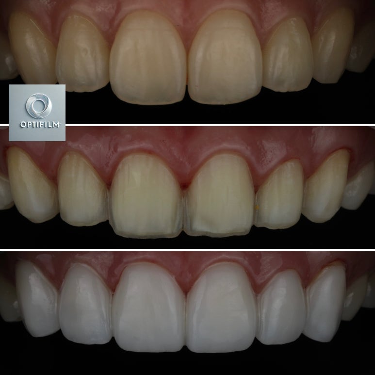 OptiFilm: A Beautiful Smile Completed with Third-Generation Laminate Veneers image 6