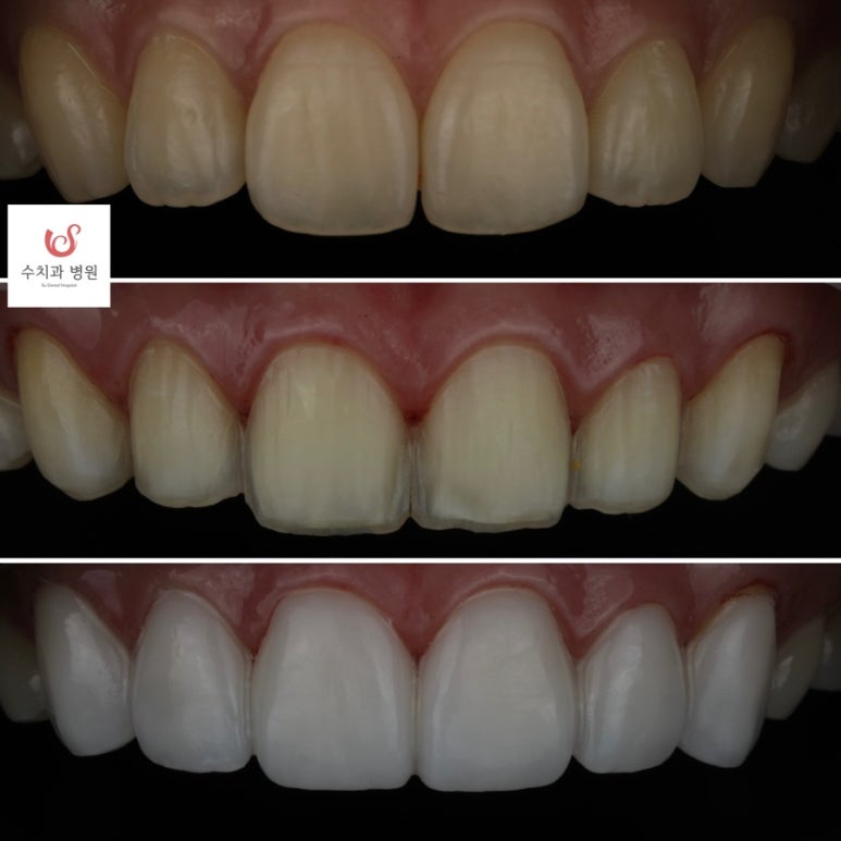 How to Find a Good Gangnam Laminate Veneers Clinic image 1