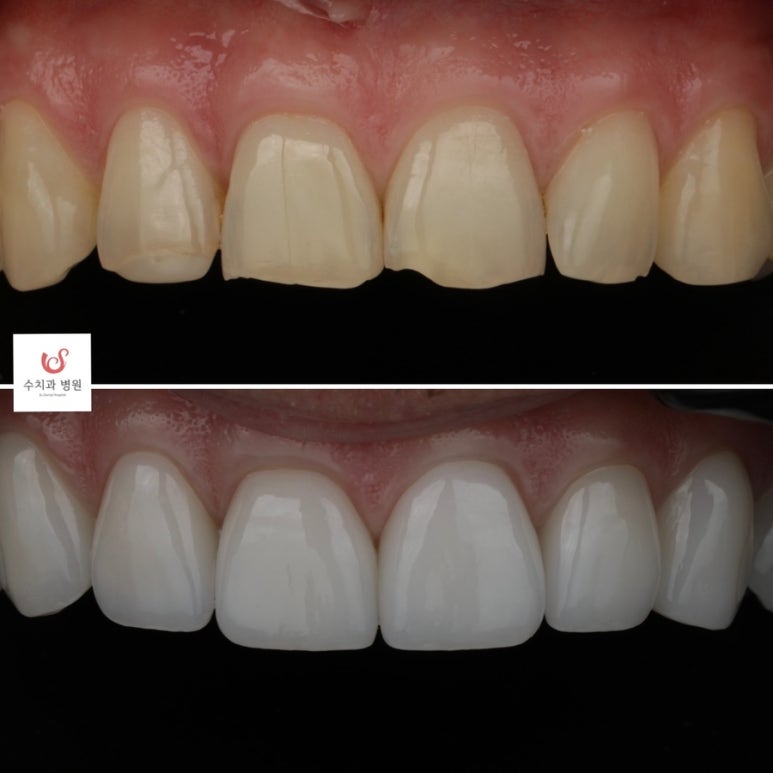 Su Dental Hospital, what do you think about laminate veneers? image 2