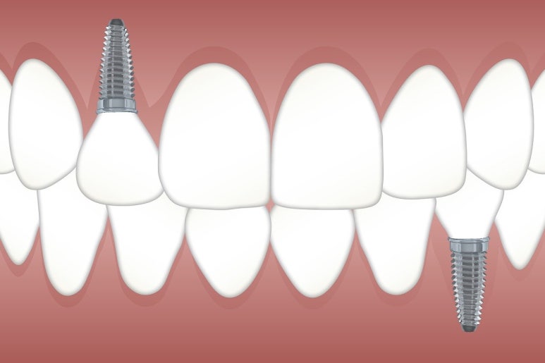 부러진앞니 급하더라도 최소 3곳은 비교해보세요. 관련 이미지 6