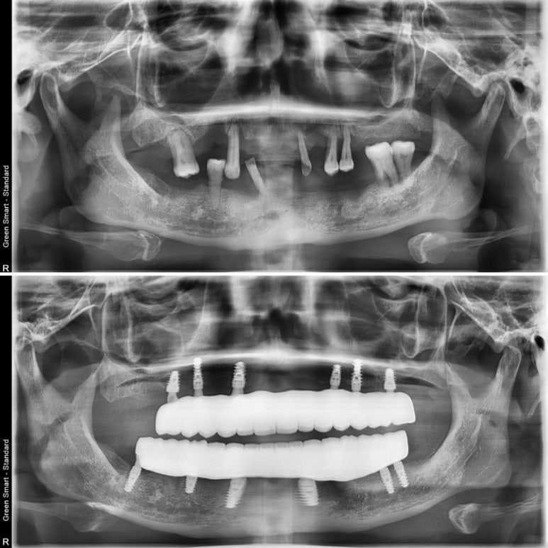 Apgujeong Straumann Implant_ All-on-X image 4