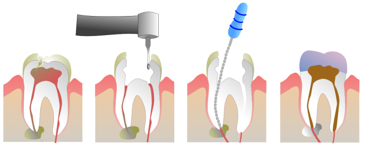 Precautions After Root Canal Treatment image 1