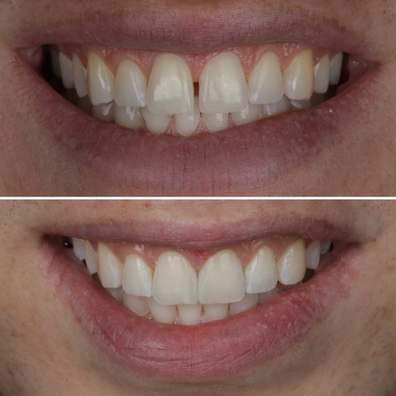 Changwon Gapped Teeth: A No-Prep BioClear Resin Veneer Case image 4