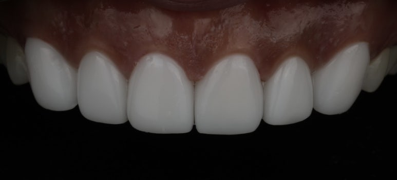 When and Why Is a One-Day Laminate Re-treatment Needed?? image 6