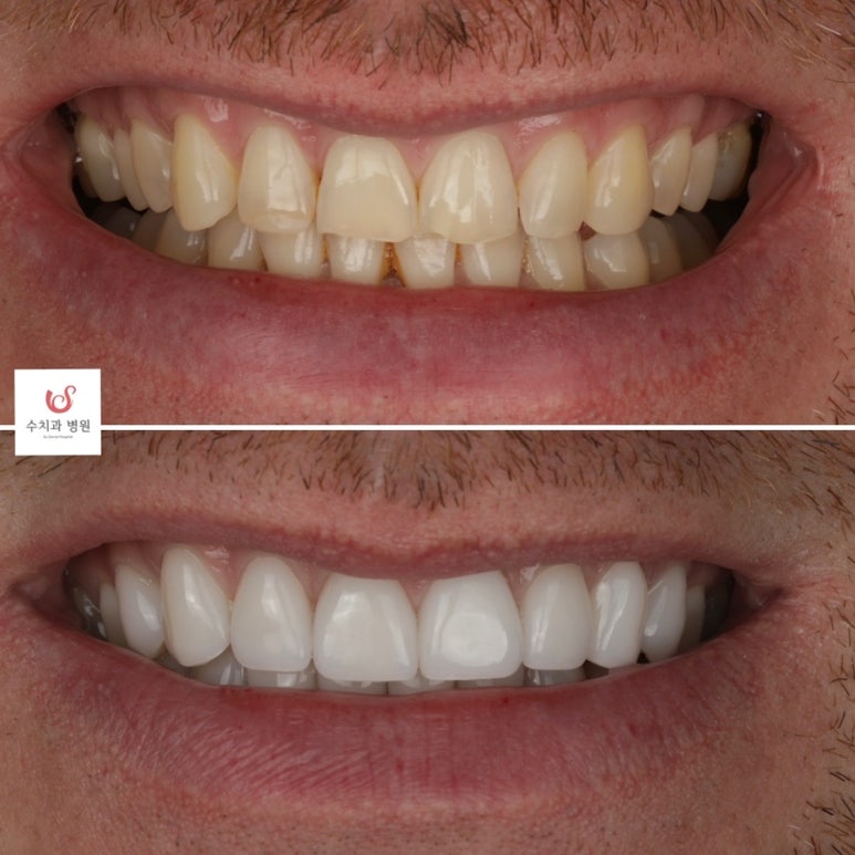 Su Dental Hospital, what do you think about laminate veneers? image 1