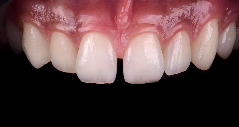 Changwon Gapped Teeth: A No-Prep BioClear Resin Veneer Case image 1