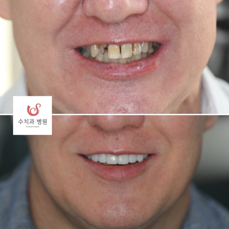 English speaking dentist in Seoul (feat. Veneers in South Korea) 관련 이미지 3