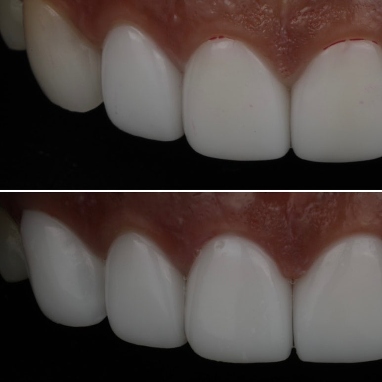When and Why Is a One-Day Laminate Re-treatment Needed?? image 5