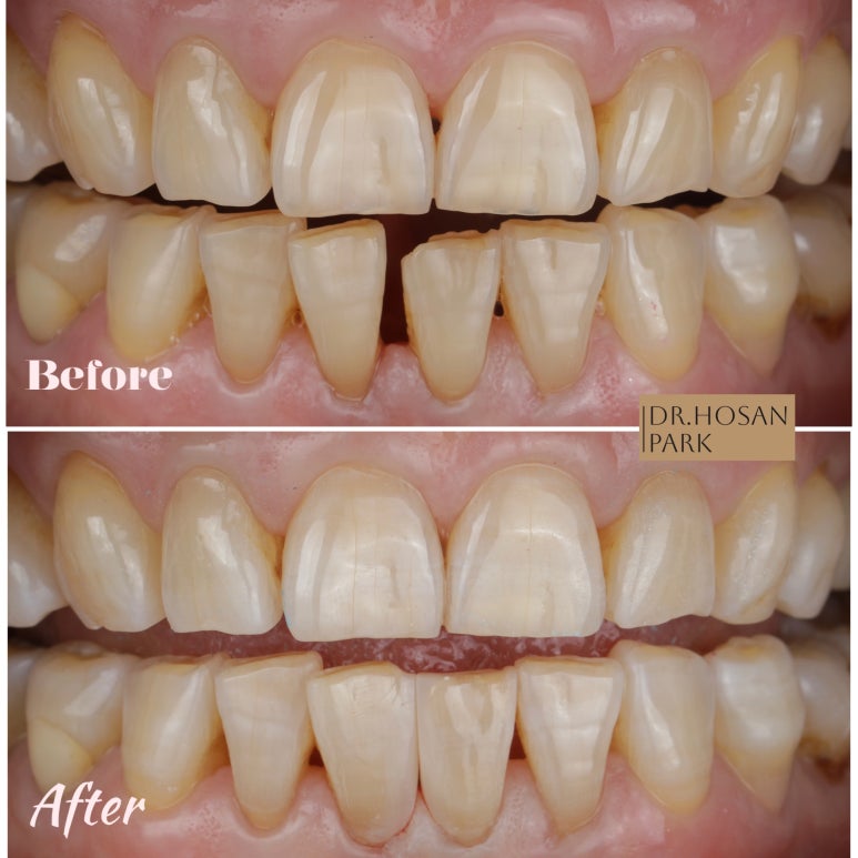 Changwon Gapped Teeth: A No-Prep BioClear Resin Veneer Case image 3