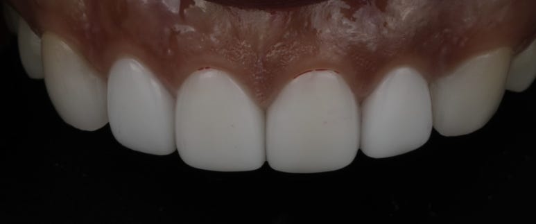 When and Why Is a One-Day Laminate Re-treatment Needed?? image 4