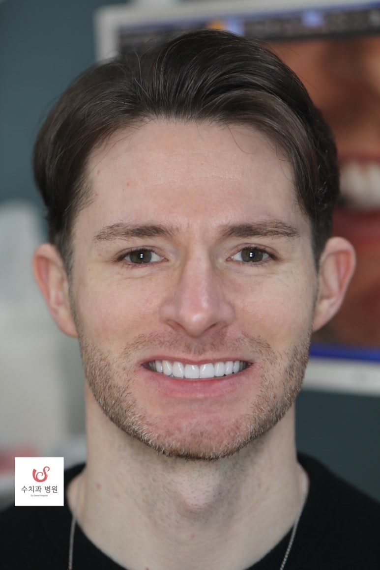 Su Dental Hospital, what do you think about laminate veneers? image 4