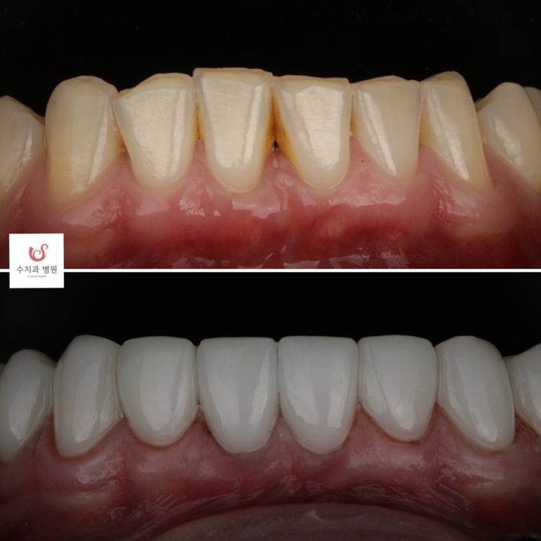 Su Dental Hospital, what do you think about laminate veneers? image 3