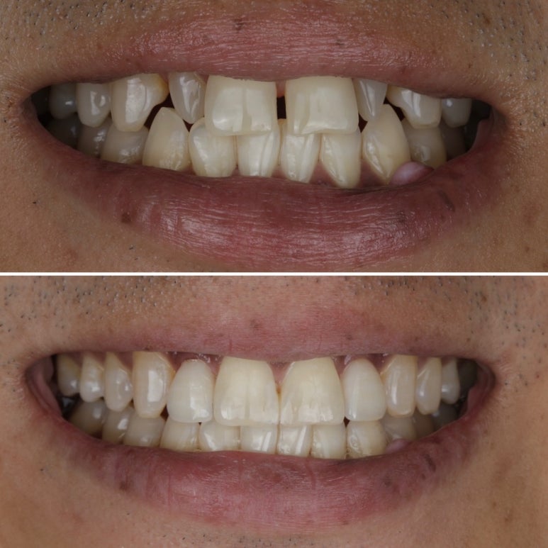 Changwon Gapped Teeth: A No-Prep BioClear Resin Veneer Case image 5