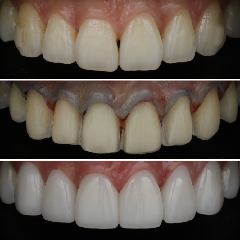 Samsung Jungang Station One-Day Laminates—Can They Really Be Completed in One Day? We Confirmed It at Sera Dental Clinic image 1
