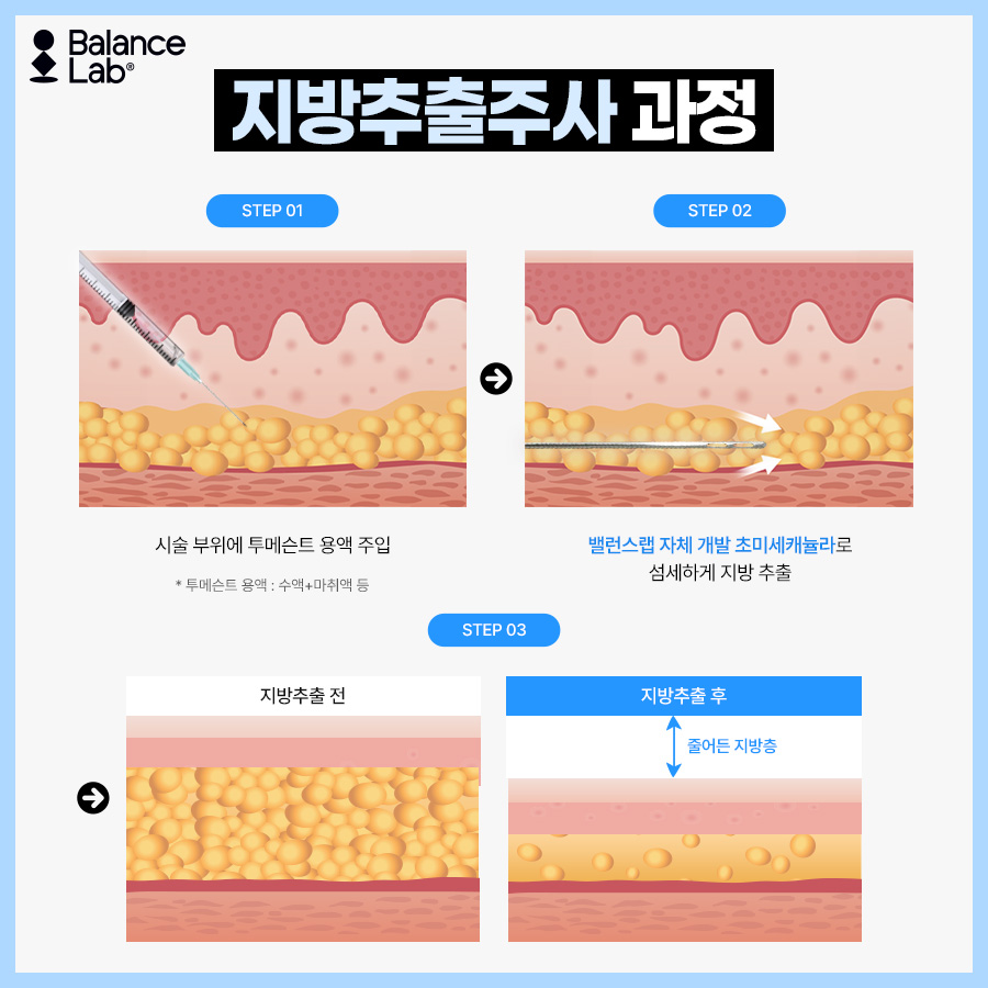 끝까지 안 빠지는 승마살, 허벅지지방추출주사로 허벅지살빼는법 관련 이미지 4