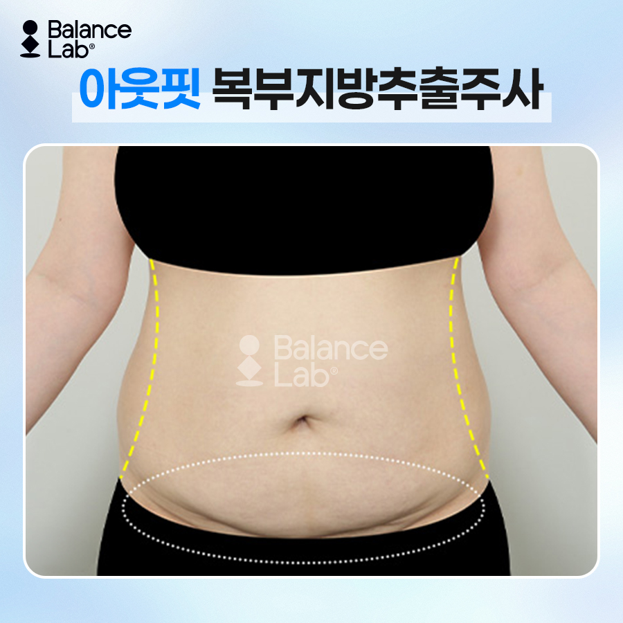 뱃살빼는법, 운동만으로 안 빠진다면? 복부지방흡입과 지방추출주사 관련 이미지 6