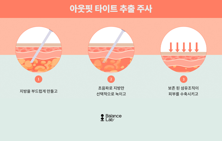 지방분해주사패키지 다가오는 여름휴가를 위하여 관련 이미지 9