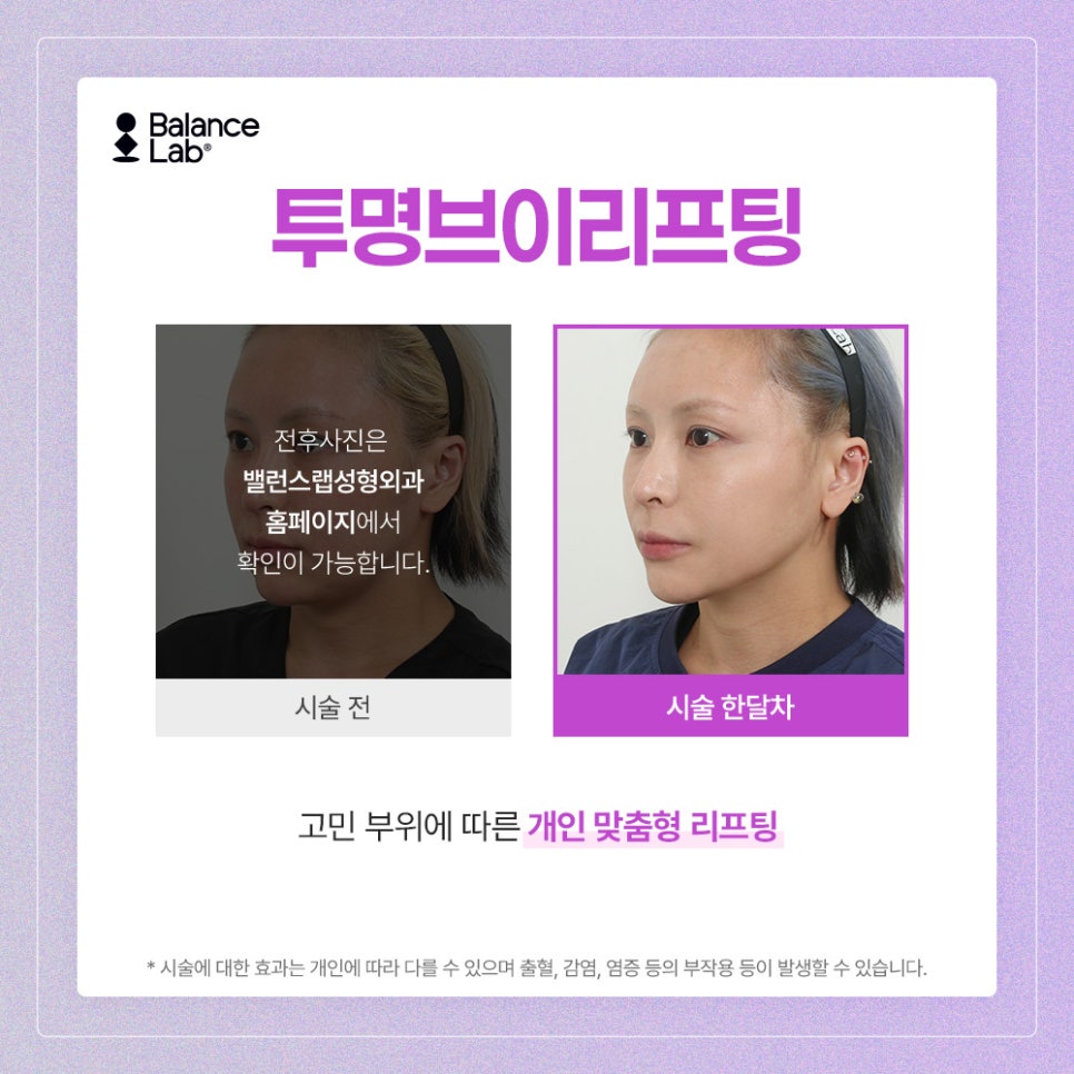 Can Midface Lifting Reduce the Appearance of a Long Midface at Balance Lab? image 5