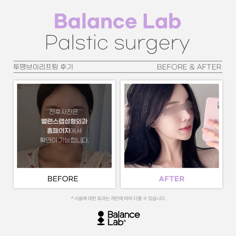Thread Lifting That Really Works with Long-Thread Fascial Fixation image 6