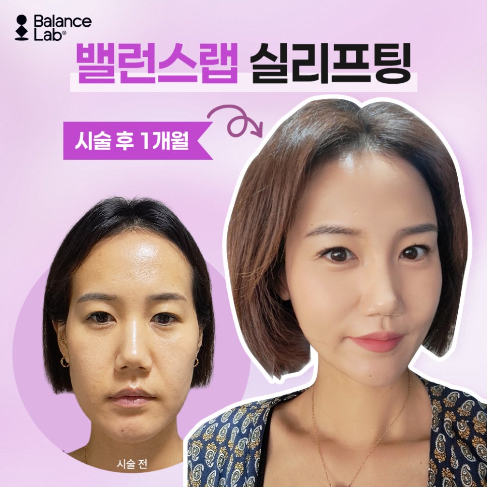 Can Midface Lifting Reduce the Appearance of a Long Midface at Balance Lab? image 2