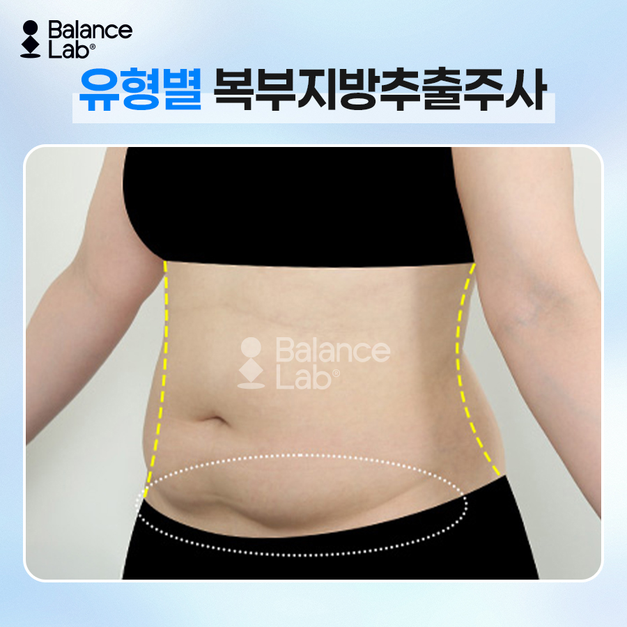 뱃살빼는법, 운동만으로 안 빠진다면? 복부지방흡입과 지방추출주사 관련 이미지 5