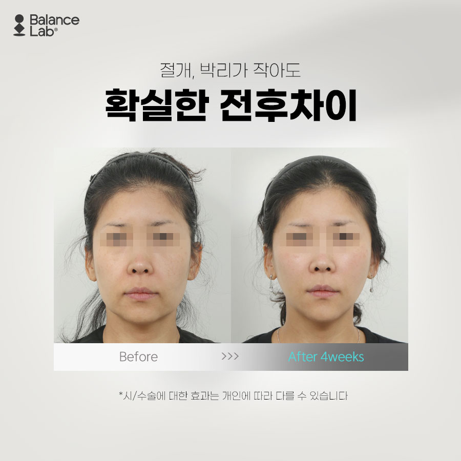 Why is Double-Fixation SMAS Lifting an Effective Mini Facelift?!😲 image 5