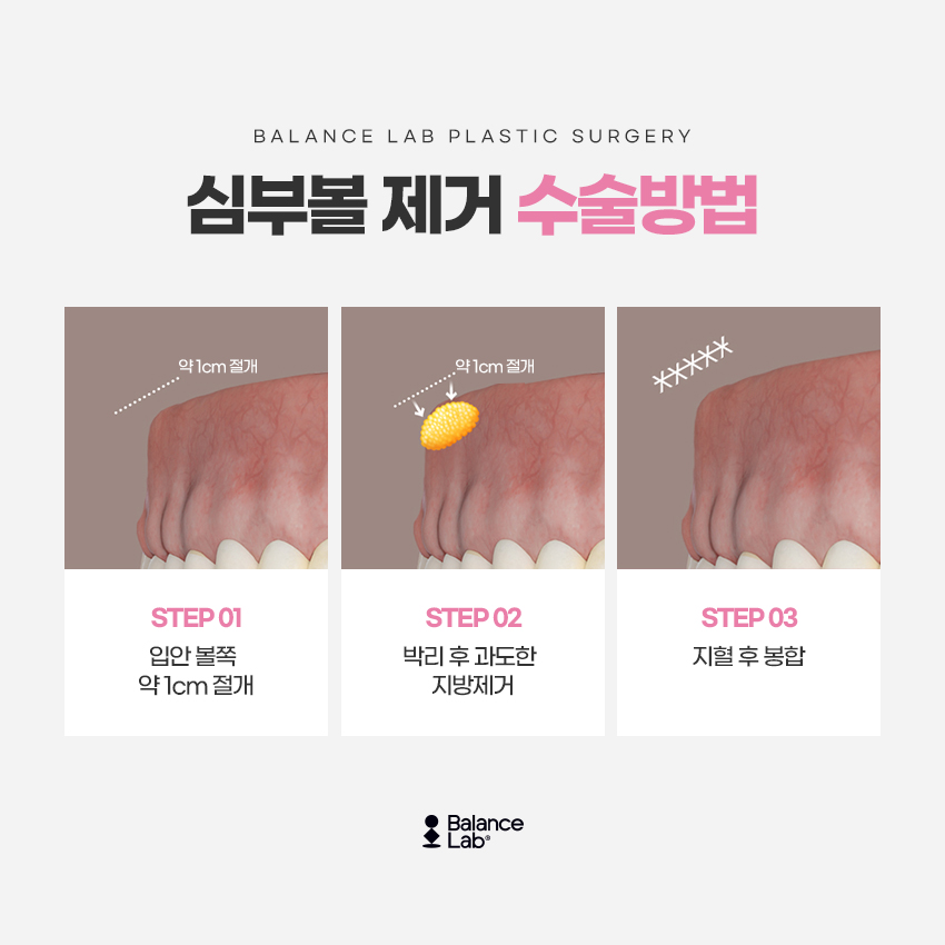 불독살심부볼 제거와 마리오네트리프팅이 필요한 경우는? 관련 이미지 3