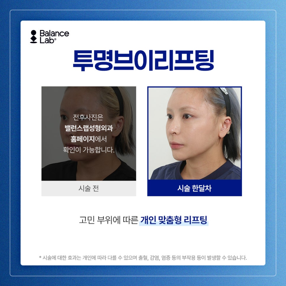 안면윤곽 후 처짐, 투명브이리프팅이 고려되는 이유 관련 이미지 2
