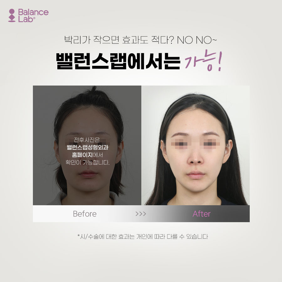 밸런스랩에서 받은 미니리프팅 후기가 좋을 수 있는 이유😋 관련 이미지 4