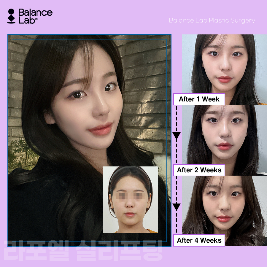 신사역 실 리프팅 잘하는 곳 밸런스랩 투명브이리프팅 후기😍 관련 이미지 2