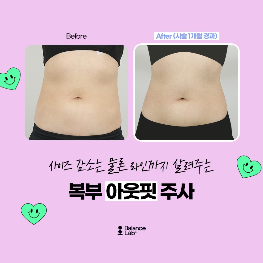 옆구리추출주사 강남지방흡입 부위별 특징에 따라 관련 이미지 5