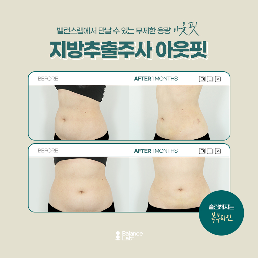 If You’re Curious About the Review and Effectiveness of Liposuction Injections for Side Fat image 3