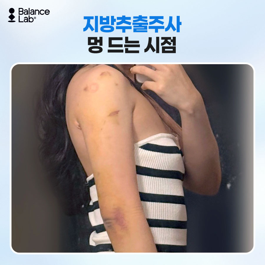 팔뚝지방추출주사, 멍·부기는 언제까지 갈까? 이장원 원장이 답하는 효과와 유지기간 관련 이미지 4