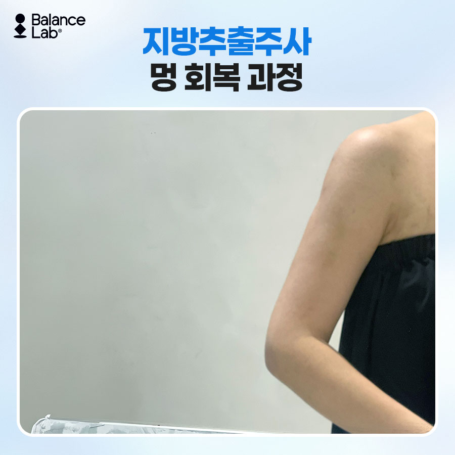 팔뚝지방추출주사, 멍·부기는 언제까지 갈까? 이장원 원장이 답하는 효과와 유지기간 관련 이미지 5