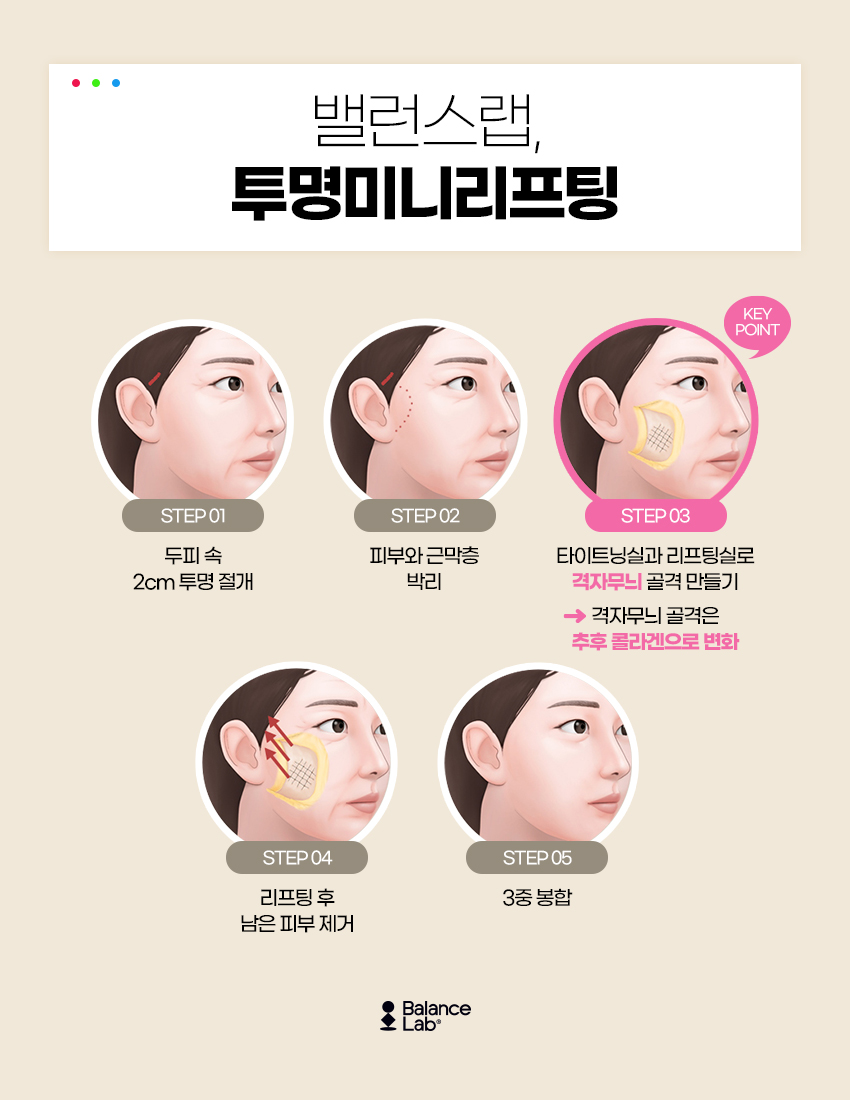 밸런스랩 성형외과에서 알려주는 미니거상 리프팅의 부작용과 장단점 관련 이미지 4