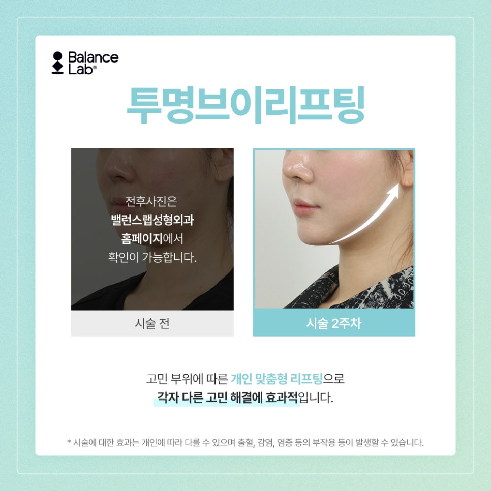Double Chin Before-and-After Difference-Clear Thread Lifting, Transparent V Lifting image 6