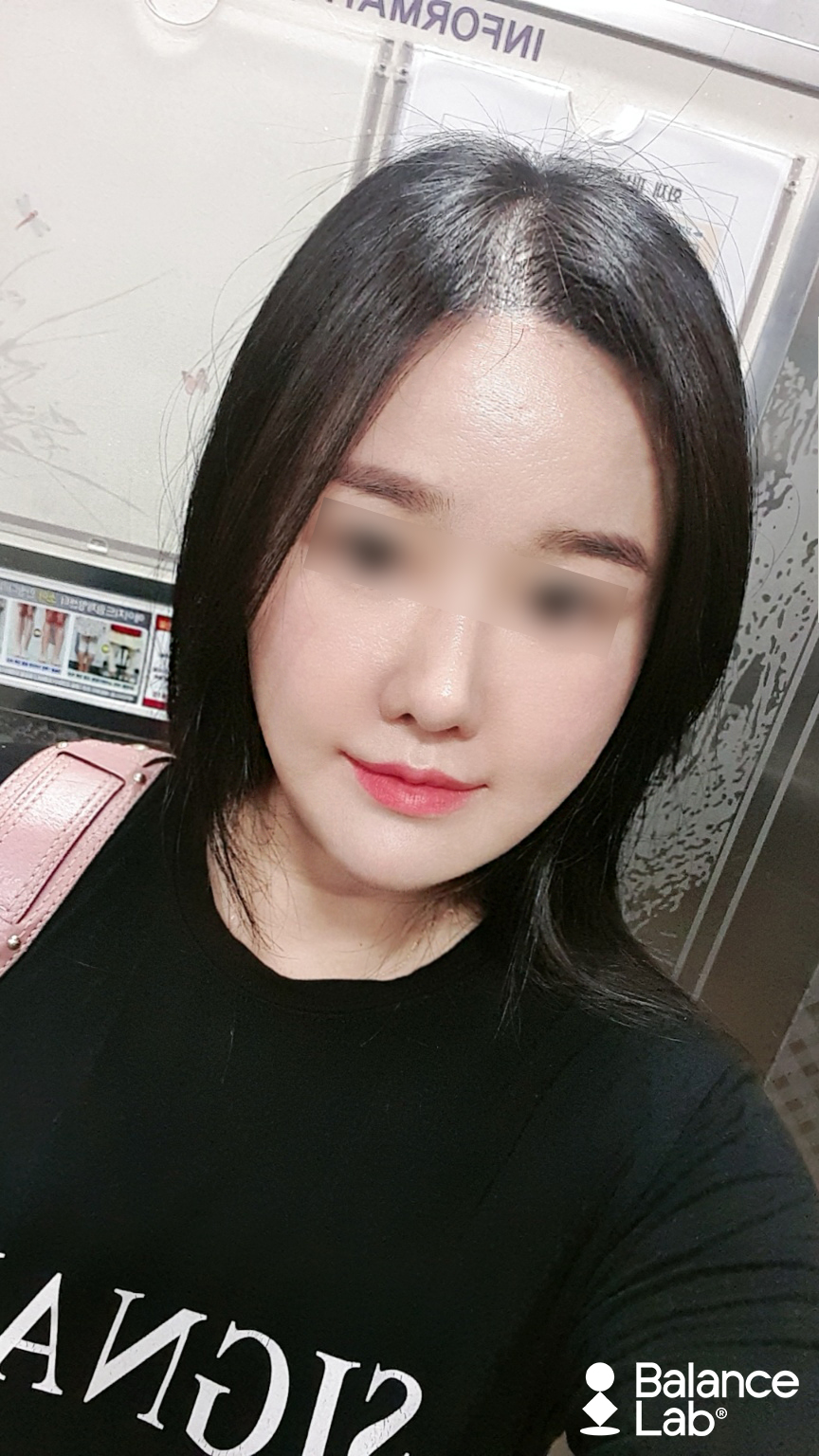 Thread Lifting Has Amazing Effects—So Why Not Do It?? (Balance Lab Transparent V Lifting) image 1