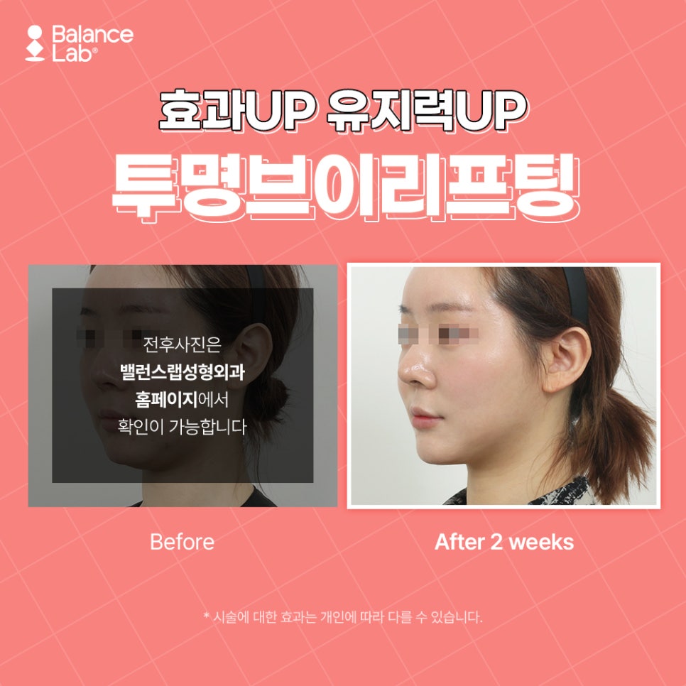 Thread Lifting Has Amazing Effects—So Why Not Do It?? (Balance Lab Transparent V Lifting) image 6