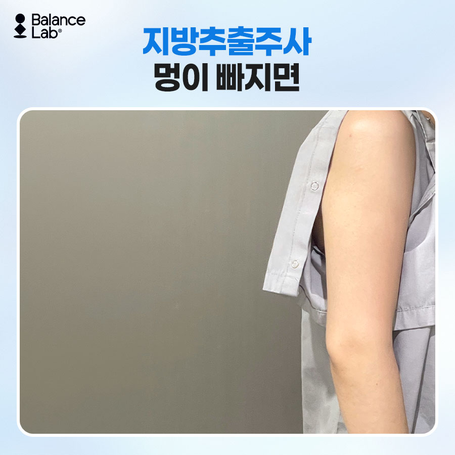 팔뚝지방추출주사, 멍·부기는 언제까지 갈까? 이장원 원장이 답하는 효과와 유지기간 관련 이미지 6