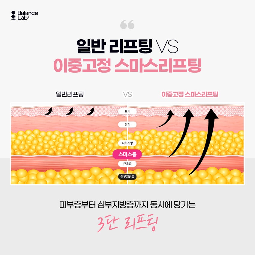얼굴 V라인시술을 대체하는 이중고정 스마스리프팅 이란? 관련 이미지 3