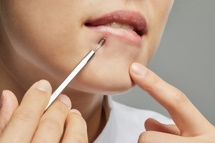 Types of Acne Scars, and How Can You Improve Scars? image 8