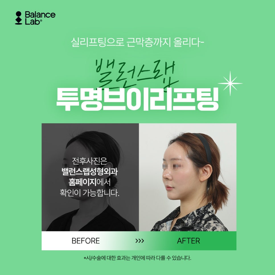 근막까지 올려주는 실리프팅 유지기간 끝내줌 (신사역 성형외과) 관련 이미지 6