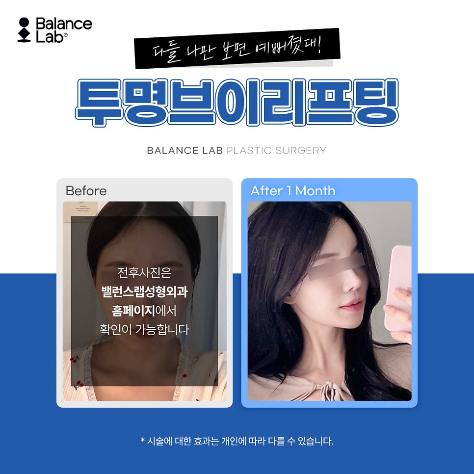 I solved my deep nasolabial folds with thread lifting at Balance Lab image 5