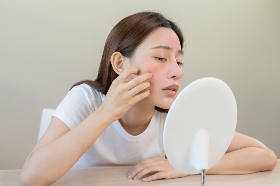 Types of Acne Scars, and How Can You Improve Scars? image 2